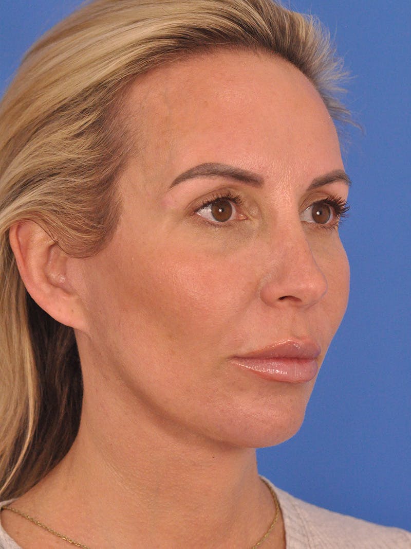 Facelift Before & After Gallery - Patient 401988 - Image 4
