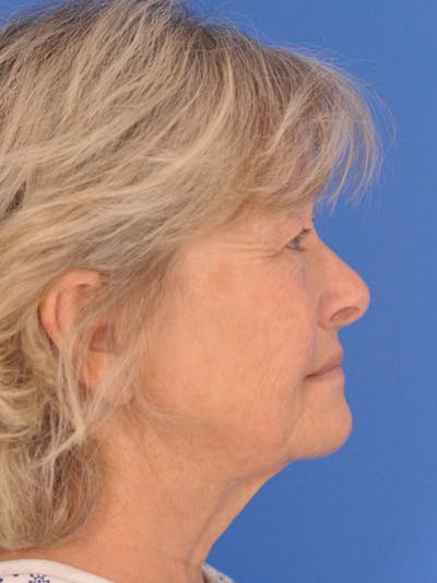 Neck Lift Before & After Gallery - Patient 567213 - Image 1