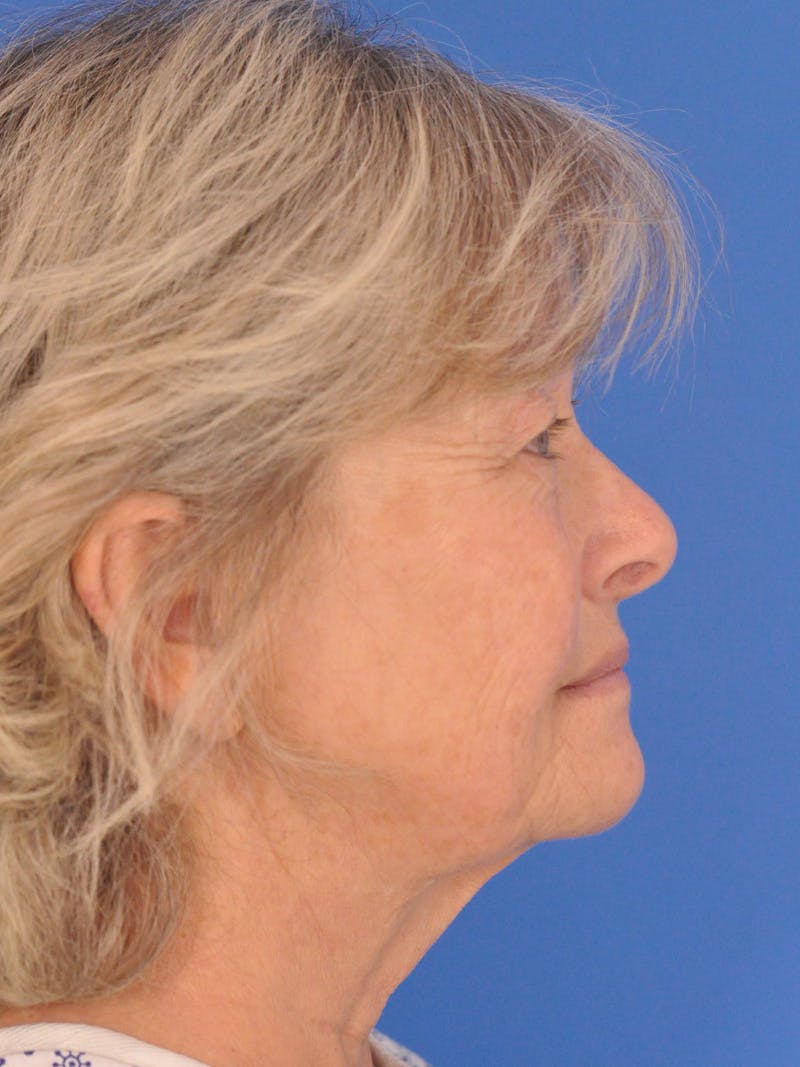 Facelift Before & After Gallery - Patient 344965 - Image 5