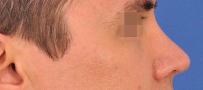 Rhinoplasty Before & After Gallery - Patient 373430 - Image 2