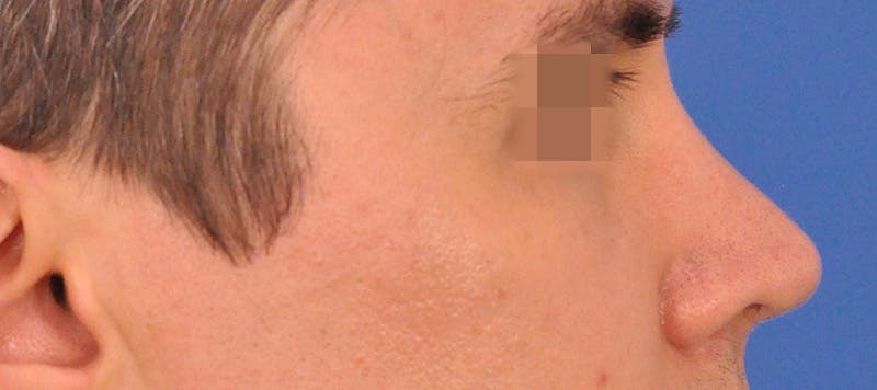 Rhinoplasty Before & After Gallery - Patient 373430 - Image 2
