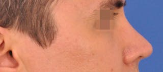Rhinoplasty Before & After Gallery - Patient 373430 - Image 2