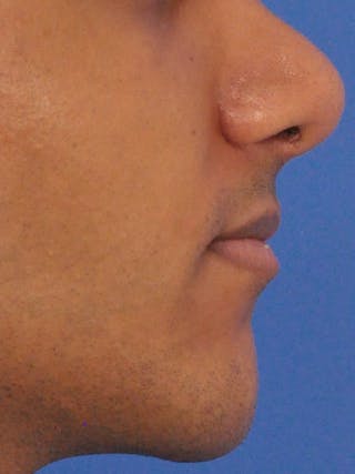 Chin Augmentation Before & After Gallery - Patient 400961 - Image 2