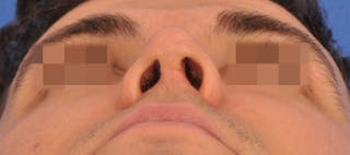 Rhinoplasty Before & After Gallery - Patient 373430 - Image 10