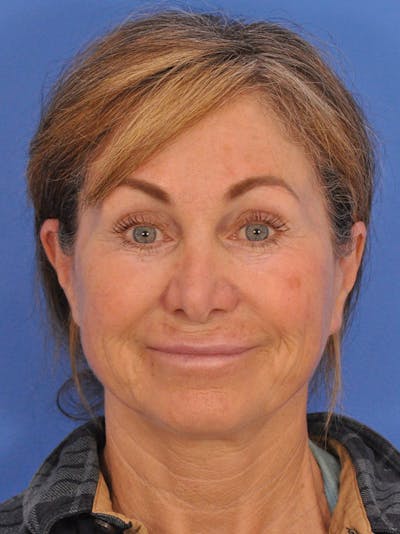 Lip Lift Before & After Gallery - Patient 261956 - Image 1