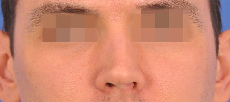 Rhinoplasty Before & After Gallery - Patient 373430 - Image 5