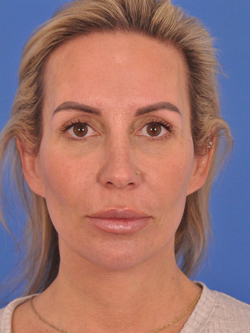 Facelift Before & After Gallery - Patient 401988 - Image 2