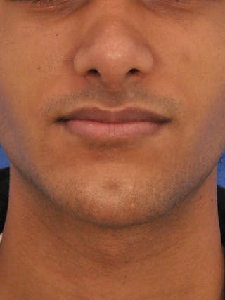 Chin Augmentation Before & After Gallery - Patient 400961 - Image 6