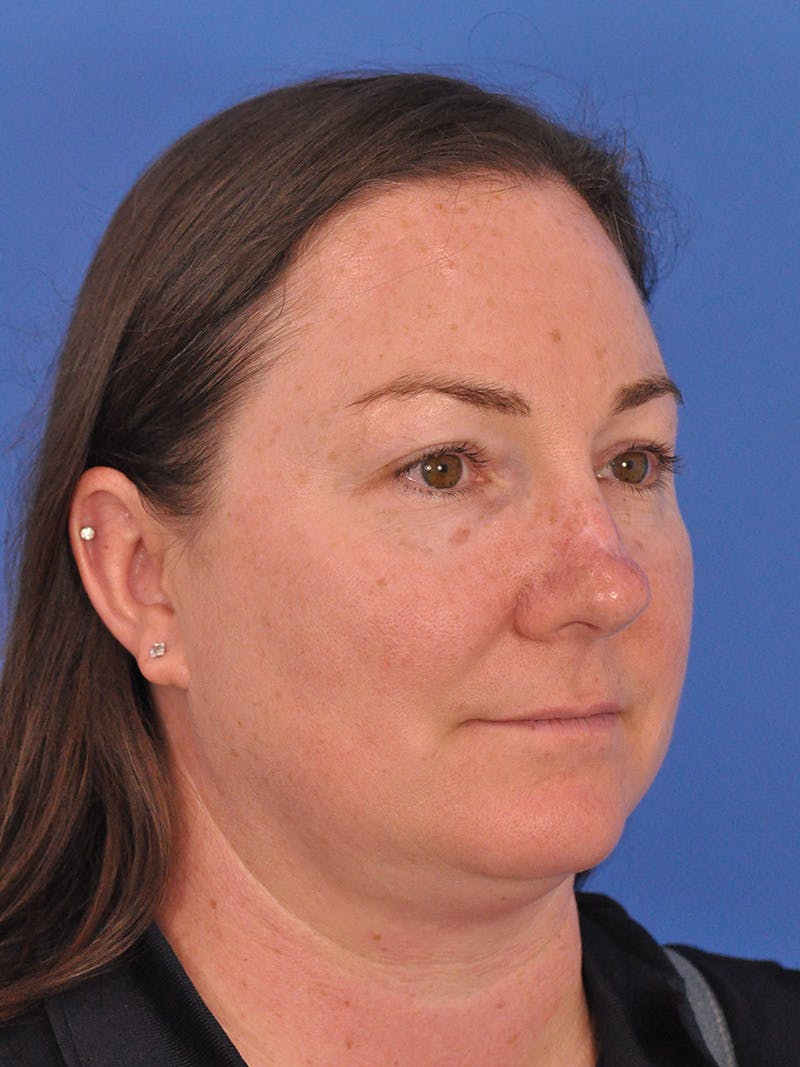CO2RE Laser Before & After Gallery - Patient 350454 - Image 3