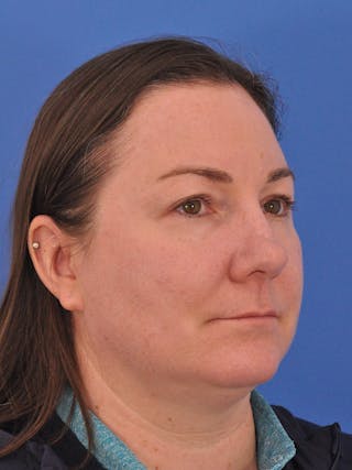 CO2RE Laser Before & After Gallery - Patient 350454 - Image 4