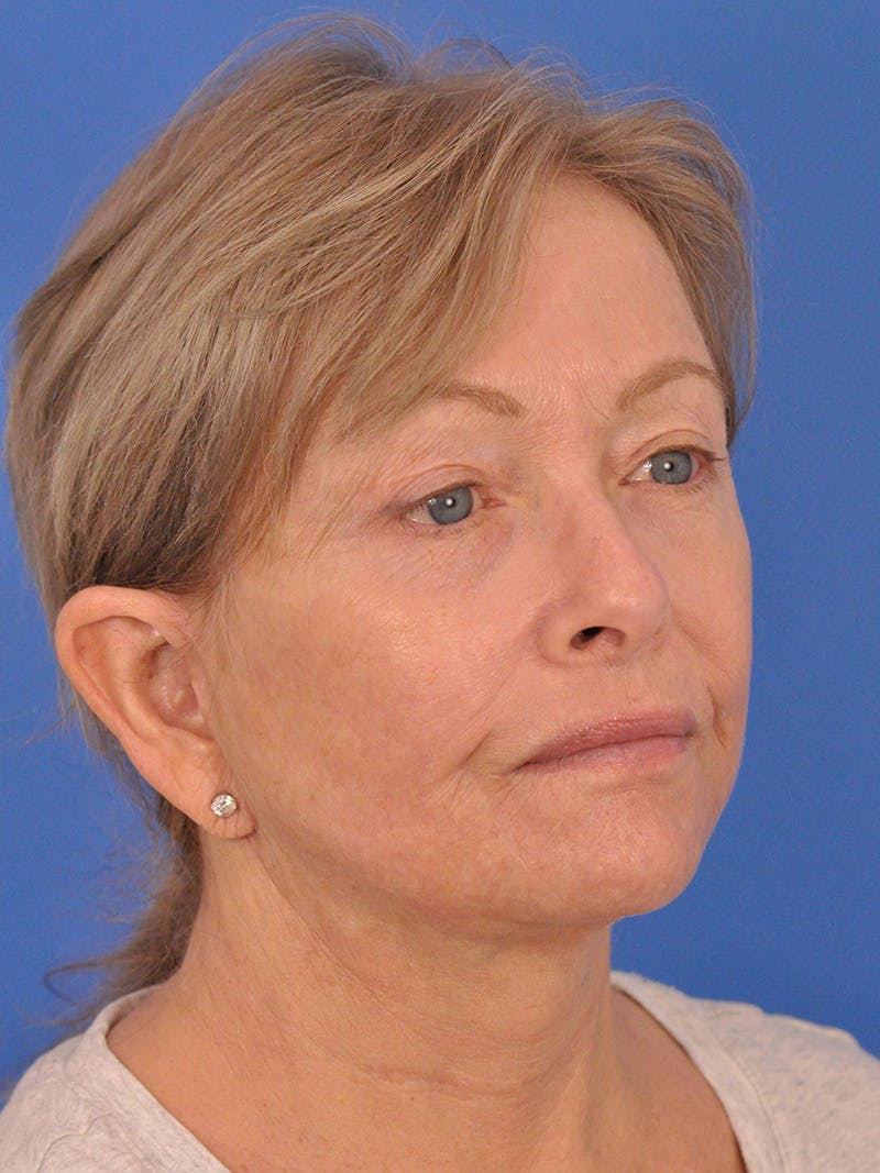 Facelift Before & After Gallery - Patient 344965 - Image 4