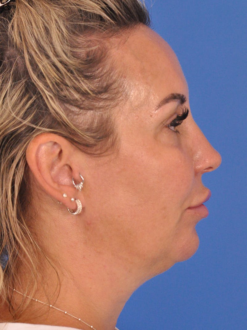 Facelift Before & After Gallery - Patient 401988 - Image 5