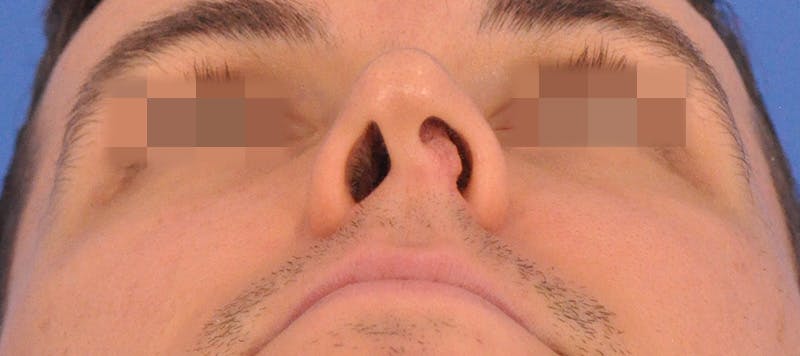 Rhinoplasty Before & After Gallery - Patient 373430 - Image 9
