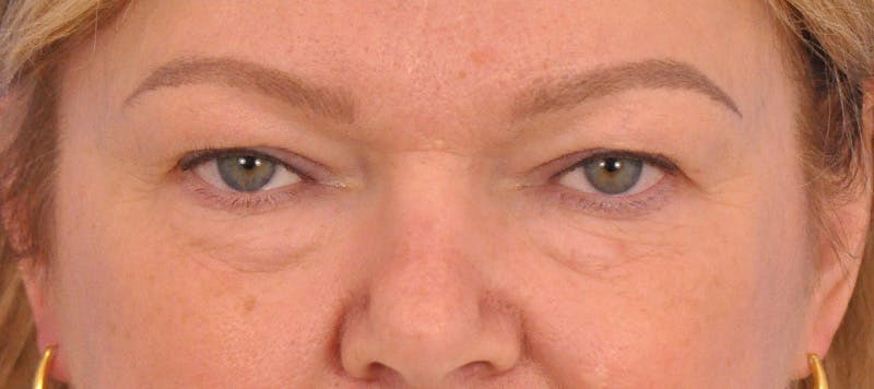 Blepharoplasty Before & After Gallery - Patient 413757 - Image 1