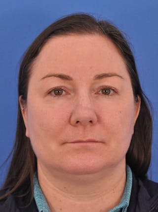 CO2RE Laser Before & After Gallery - Patient 350454 - Image 2