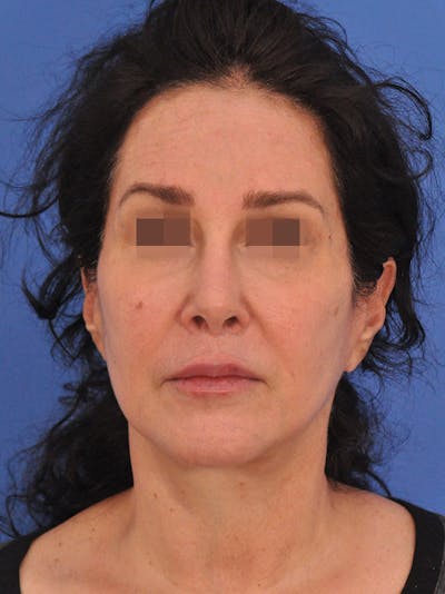 Lip Lift Before & After Gallery - Patient 124863 - Image 2