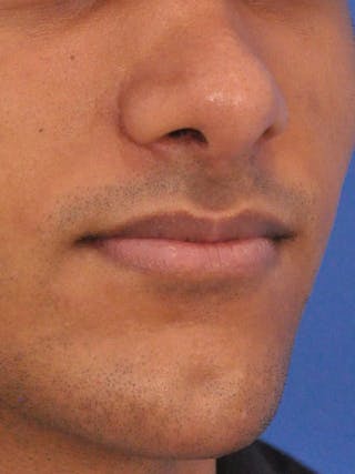 Chin Augmentation Before & After Gallery - Patient 400961 - Image 4
