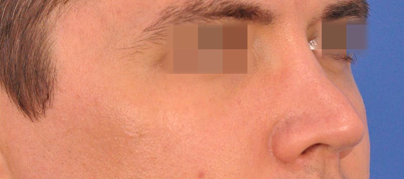 Rhinoplasty Before & After Gallery - Patient 373430 - Image 4