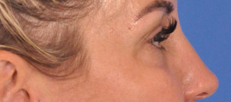 Blepharoplasty Before & After Gallery - Patient 553105 - Image 5