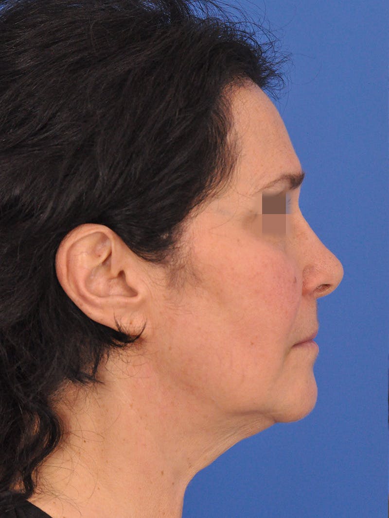Lip Lift Before & After Gallery - Patient 124863 - Image 5