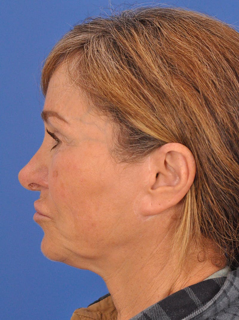 Lip Lift Before & After Gallery - Patient 261956 - Image 9