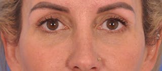 Blepharoplasty Before & After Gallery - Patient 553105 - Image 2
