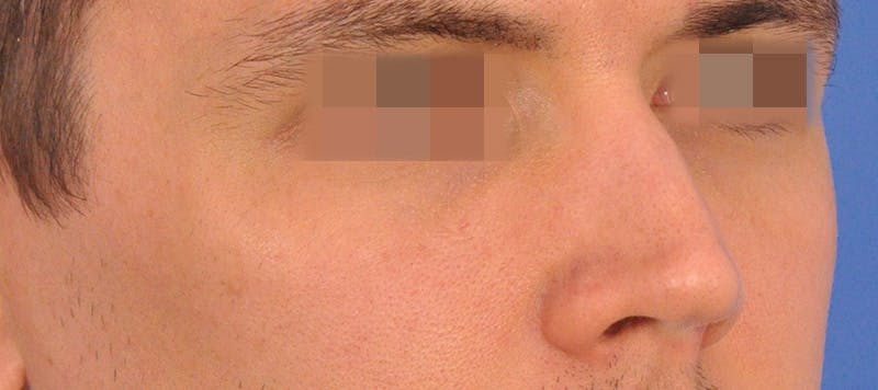 Rhinoplasty Before & After Gallery - Patient 373430 - Image 3