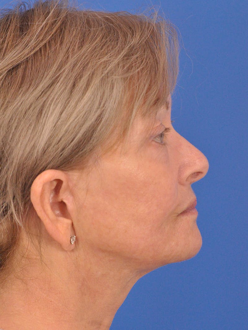Facelift Before & After Gallery - Patient 344965 - Image 6
