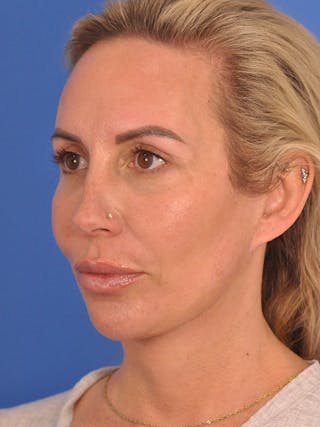 Neck Lift Before & After Gallery - Patient 143049 - Image 8