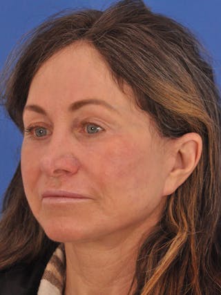 Neck Lift Before & After Gallery - Patient 388526 - Image 8