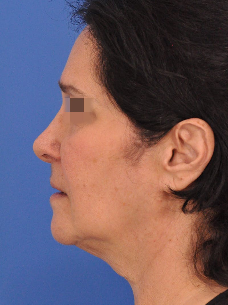 Lip Lift Before & After Gallery - Patient 124863 - Image 10