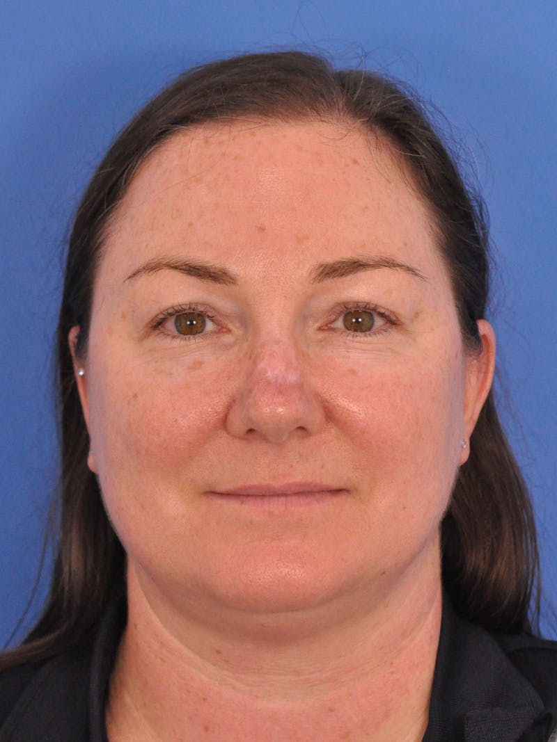 CO2RE Laser Before & After Gallery - Patient 350454 - Image 1