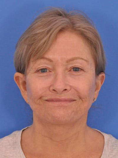 Blepharoplasty Before & After Gallery - Patient 282891 - Image 2