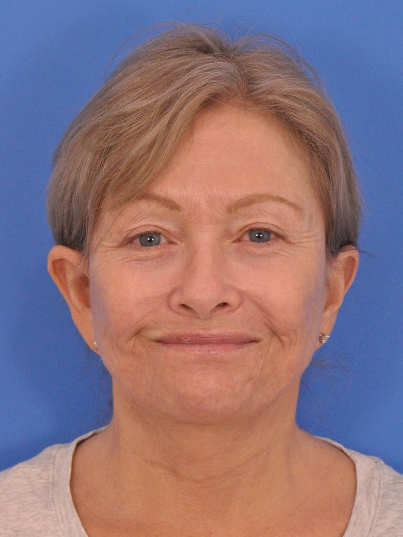 Facelift Before & After Gallery - Patient 344965 - Image 2