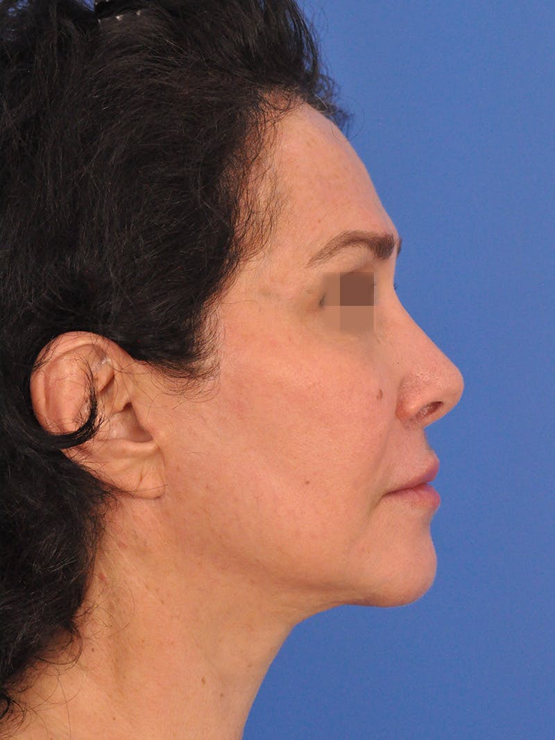 Lip Lift Before & After Gallery - Patient 124863 - Image 6