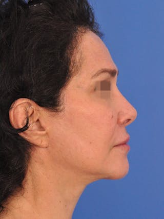 CO2RE Laser Before & After Gallery - Patient 360894 - Image 6