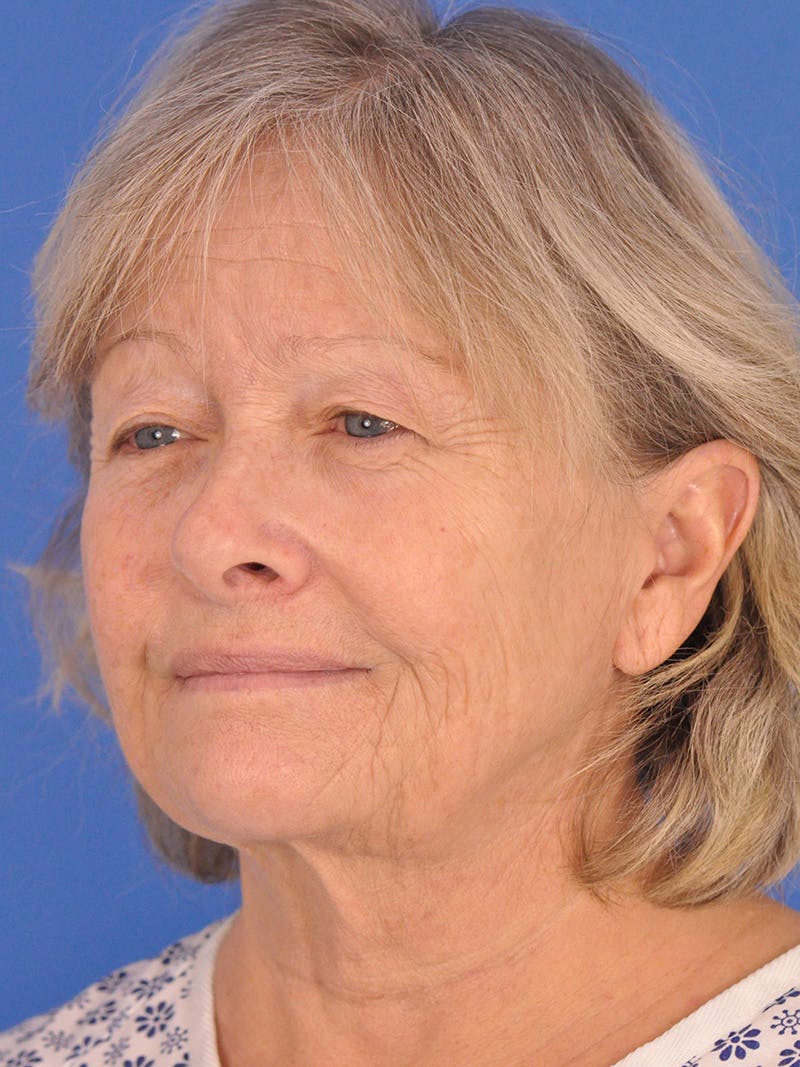 Facelift Before & After Gallery - Patient 344965 - Image 7