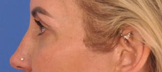 Blepharoplasty Before & After Gallery - Patient 553105 - Image 10