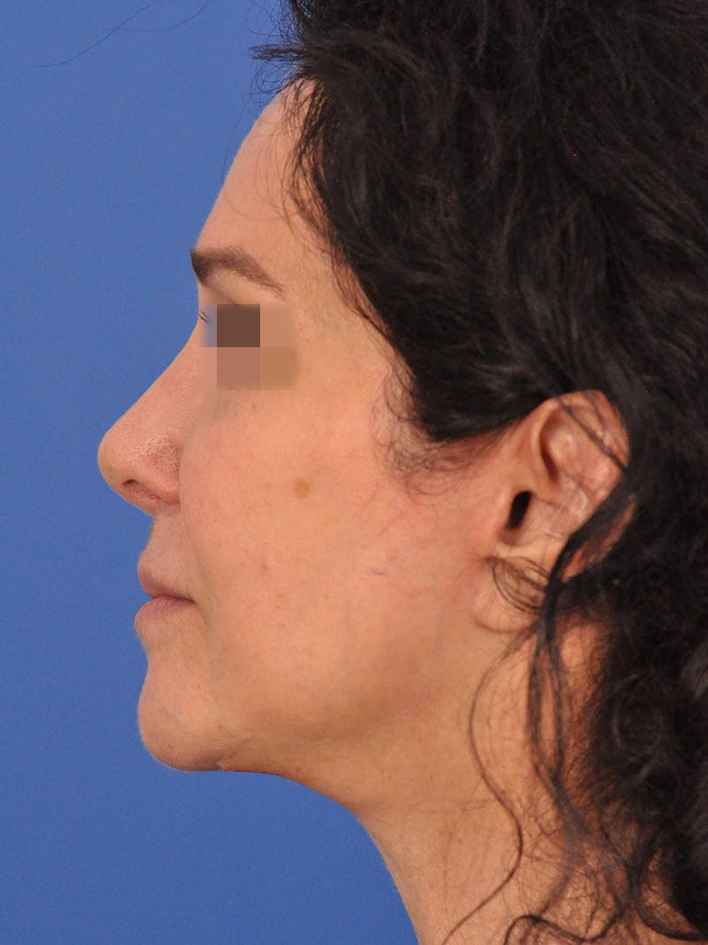Lip Lift Before & After Gallery - Patient 124863 - Image 9