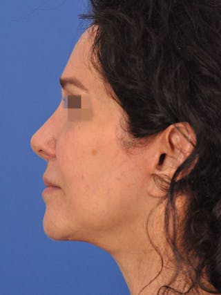 Facelift Before & After Gallery - Patient 346075 - Image 10