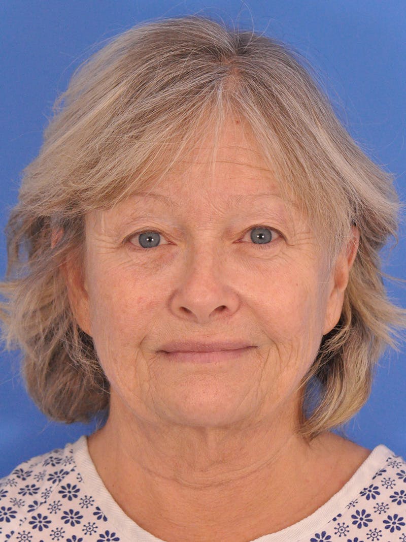 Facelift Before & After Gallery - Patient 344965 - Image 1
