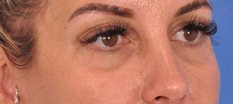 Blepharoplasty Before & After Gallery - Patient 553105 - Image 3