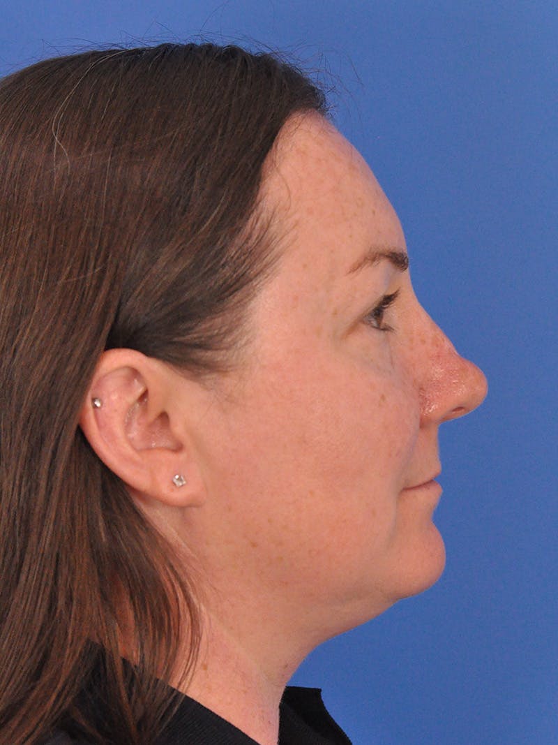 CO2RE Laser Before & After Gallery - Patient 350454 - Image 5