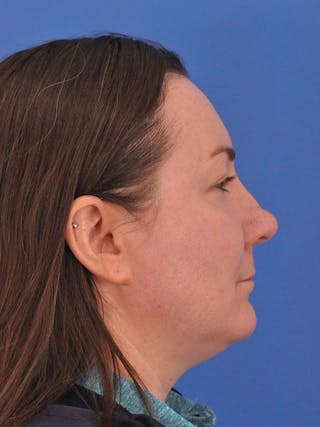CO2RE Laser Before & After Gallery - Patient 350454 - Image 6