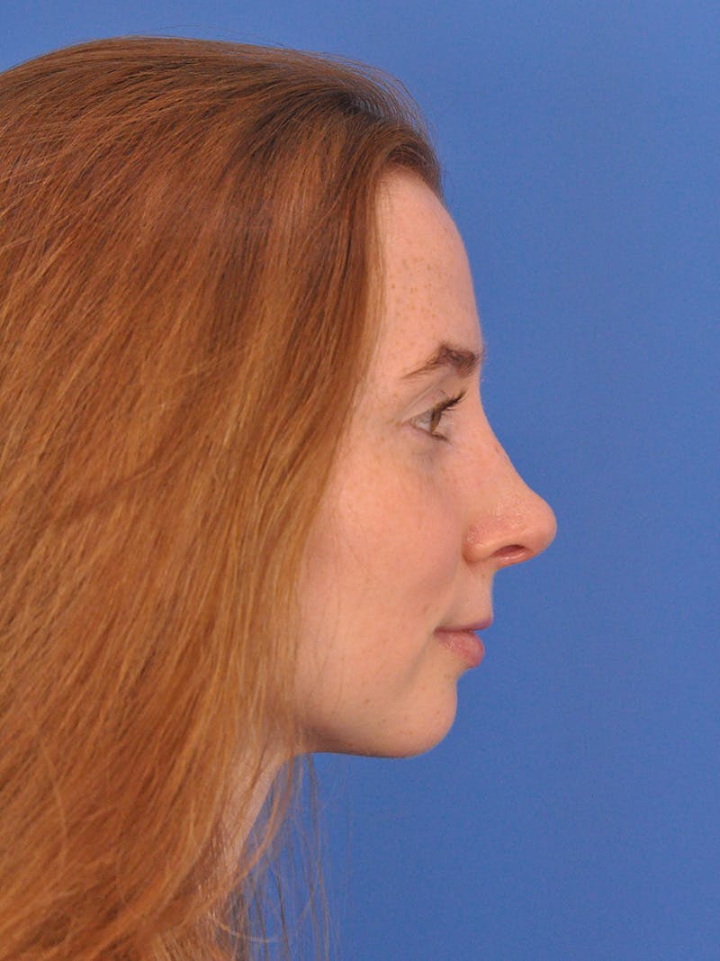 Rhinoplasty Before & After Gallery - Patient 307917 - Image 1