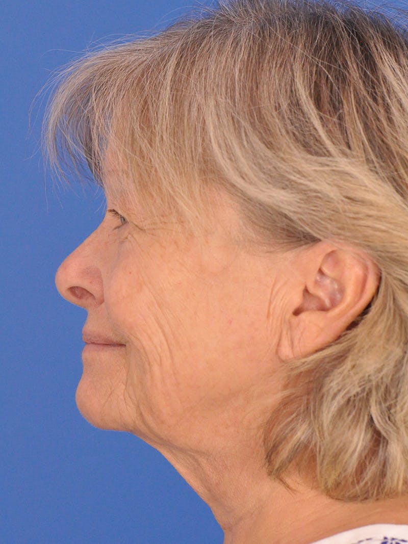 Facelift Before & After Gallery - Patient 344965 - Image 9