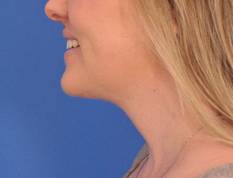 Neck Lift Before & After Gallery - Patient 144204 - Image 10
