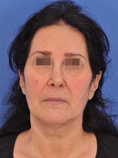 Lip Lift Before & After Gallery - Patient 124863 - Image 1