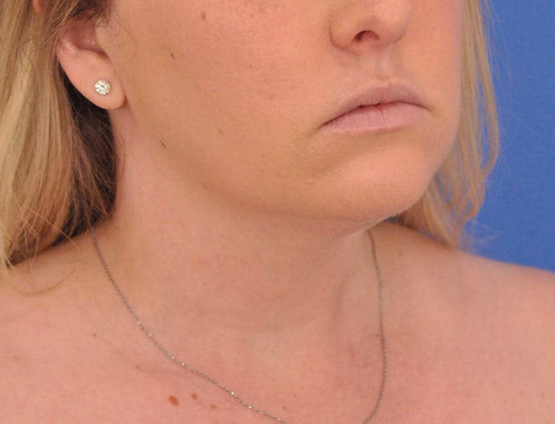 Neck Lift Before & After Gallery - Patient 144204 - Image 3