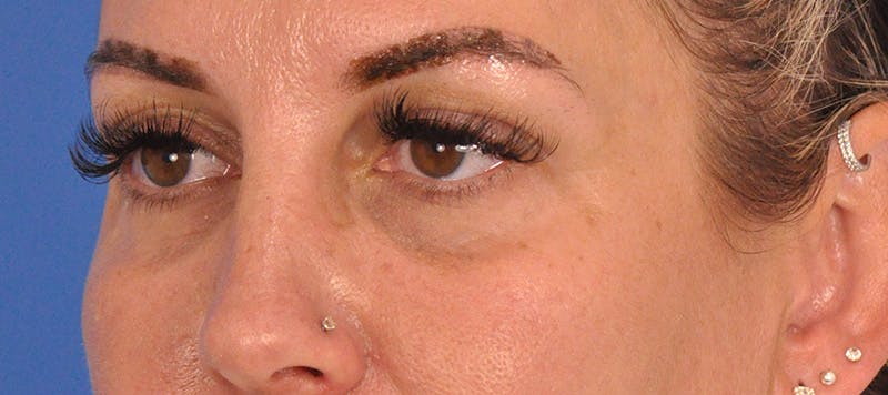 Blepharoplasty Before & After Gallery - Patient 553105 - Image 7
